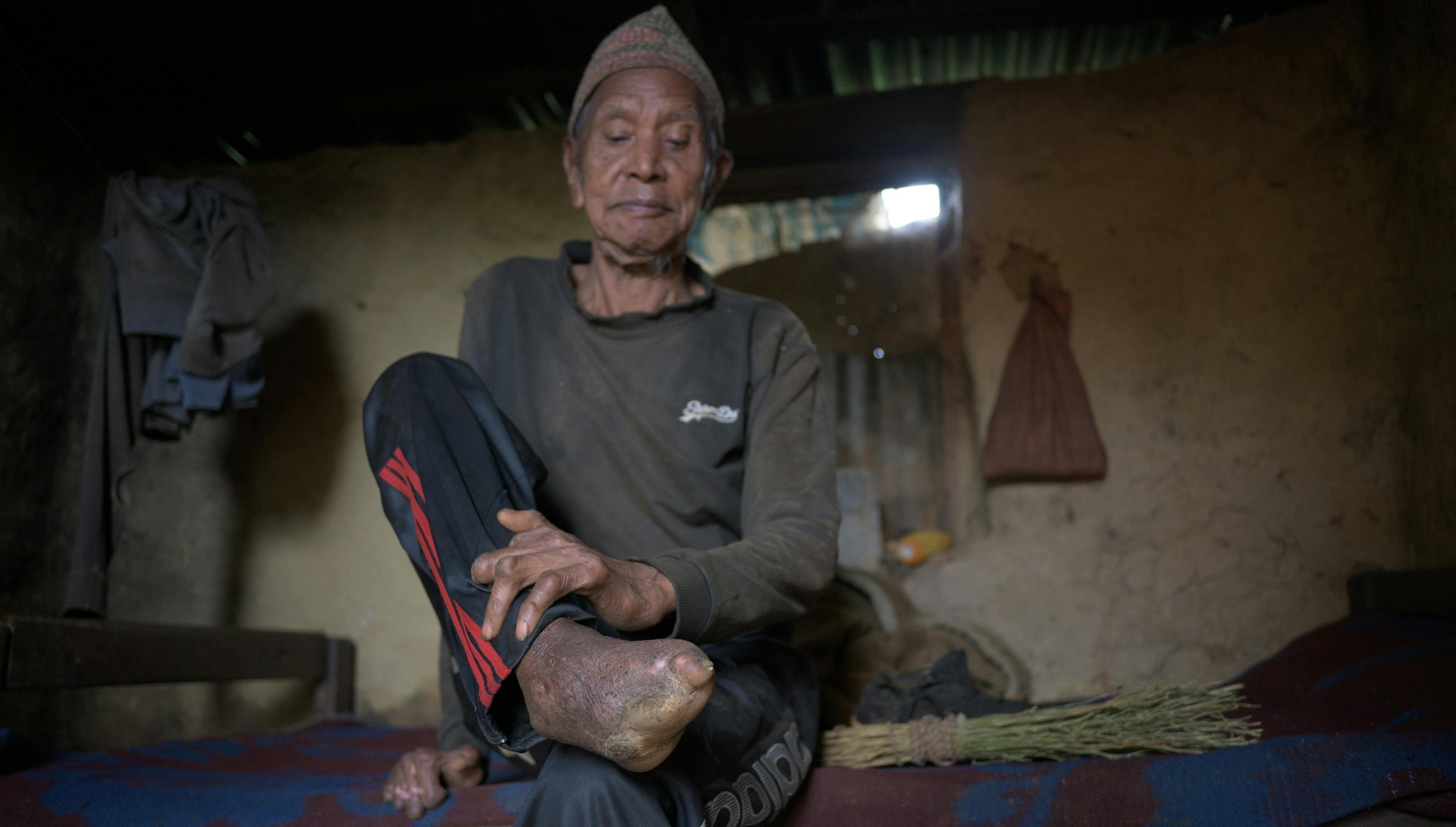 Bal Bhadadur Danuwar est assis sur un lit et tient son pied sans orteils et ses mains blessées dans le cadre.